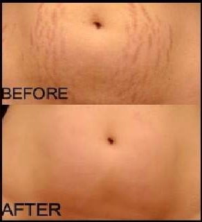 How to get rid of post-pregnancy stretch marks