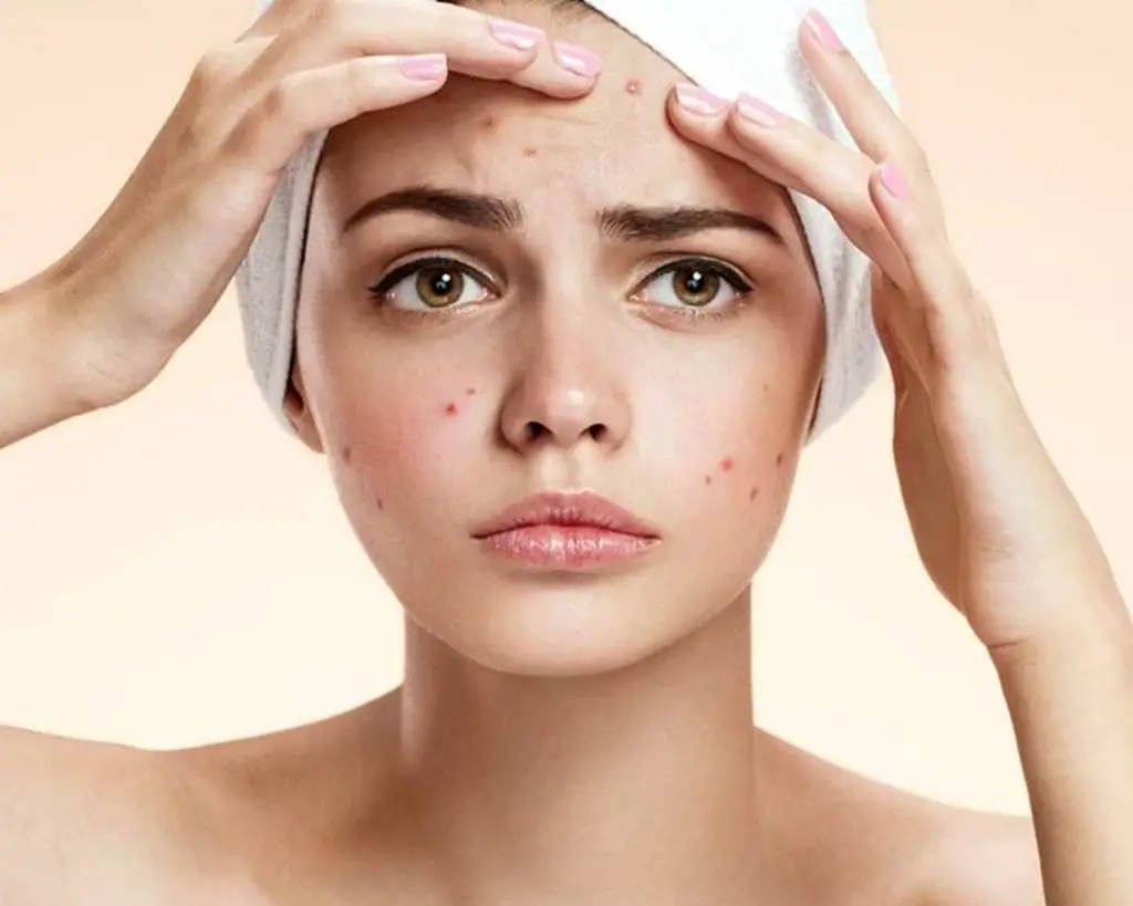 Blemishes And Increase In Hyperpigmentation On Faceon On Face