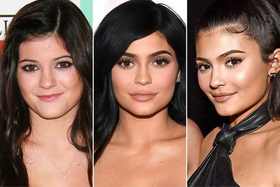 Kylie's Famous Lip Fillers:
