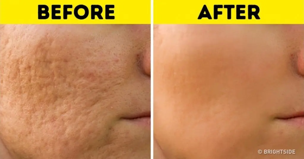 How to permanently reduce scars