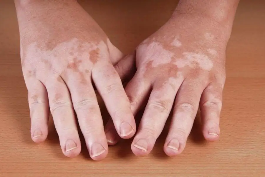 Neem Helps In Treating Vitiligo